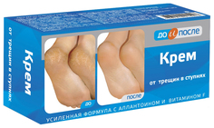 Крем для ног До и после от трещин в ступнях 150 мл No Brand